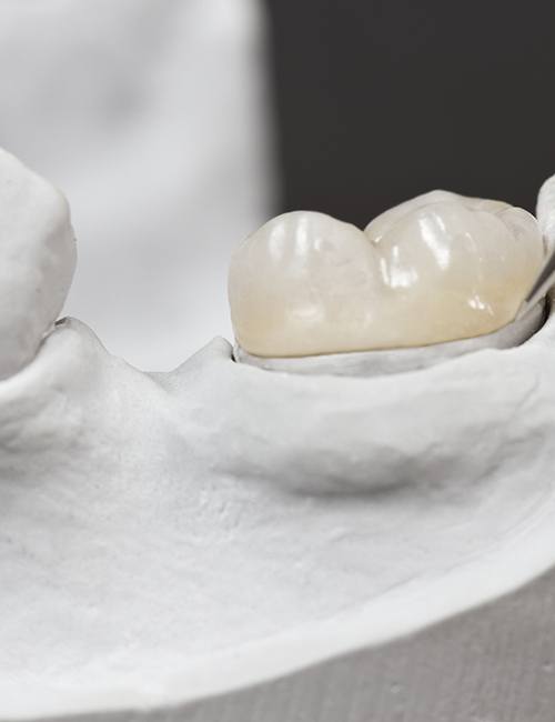 Example of one-visit dental crown in Temple