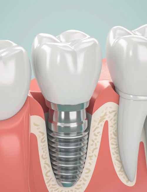 a 3D example of a dental implant in the jawbone