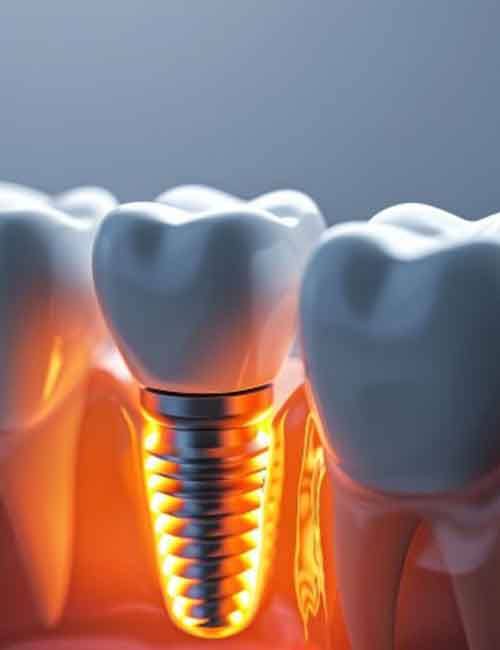 a 3D depiction of a failed dental implant