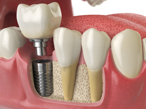 3D image of a dental implant